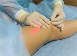 Laser Treatment for Varicose Veins: Solution for Relief